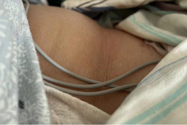 呼吸机胀气怎么排使用呼吸机引起胃肠胀气，怎么处理？_https://www.jmylbn.com_新闻资讯_第2张