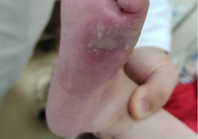 医用弹力绷带怎么取弹力绷带竟有严重并发症，护士千万要注意！_https://www.jmylbn.com_新闻资讯_第2张