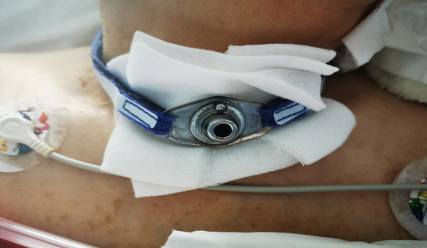 气管导管可用什么消毒金属气管内管，拔出困难怎么办？_https://www.jmylbn.com_新闻资讯_第3张