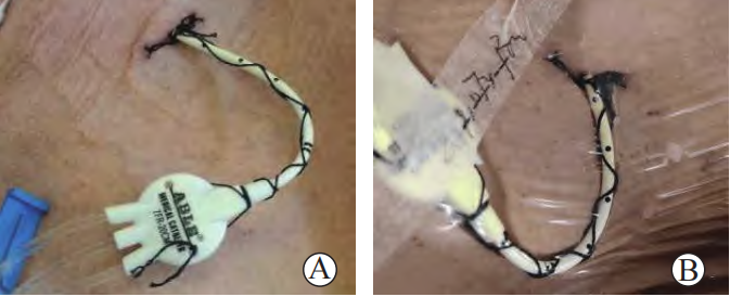 医用缝合扣怎么用CVC 卡扣必须缝皮肤上？一文说清「缝合」与「无缝合」固定！_https://www.jmylbn.com_新闻资讯_第5张