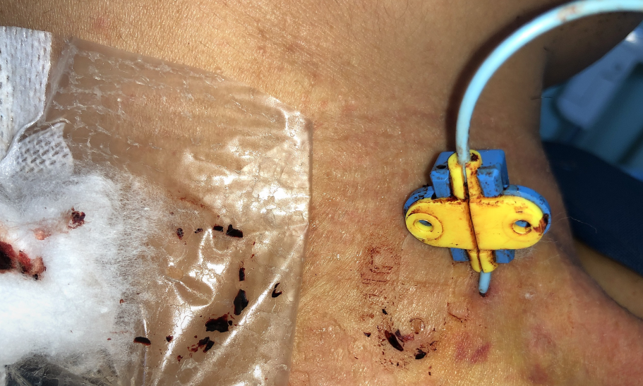 医用缝合扣怎么用CVC 卡扣必须缝皮肤上？一文说清「缝合」与「无缝合」固定！_https://www.jmylbn.com_新闻资讯_第2张