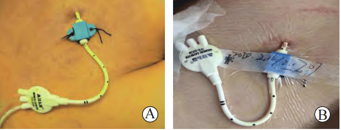 医用缝合扣怎么用CVC 卡扣必须缝皮肤上？一文说清「缝合」与「无缝合」固定！_https://www.jmylbn.com_新闻资讯_第4张