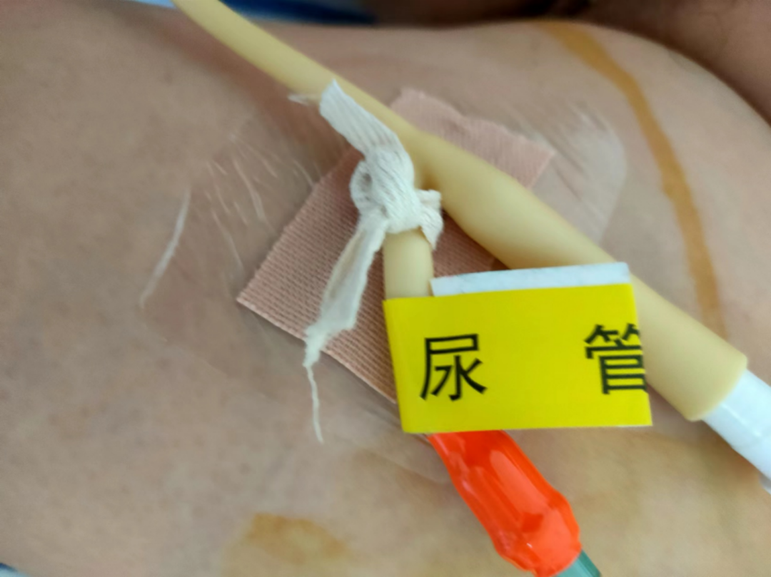尿管怎么固定导尿管二次固定总是松脱？一招轻松解决！_https://www.jmylbn.com_新闻资讯_第10张