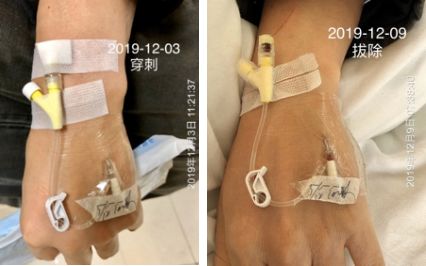 静脉留置针是干什么的为何你扎的留置针 1 天就得拔？到底是留 3 天还是 7 天？别再纠结，答案来了！_https://www.jmylbn.com_新闻资讯_第5张