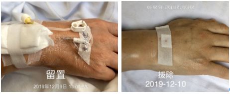 静脉留置针是干什么的为何你扎的留置针 1 天就得拔？到底是留 3 天还是 7 天？别再纠结，答案来了！_https://www.jmylbn.com_新闻资讯_第4张