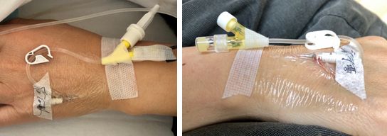 静脉留置针是干什么的为何你扎的留置针 1 天就得拔？到底是留 3 天还是 7 天？别再纠结，答案来了！_https://www.jmylbn.com_新闻资讯_第6张