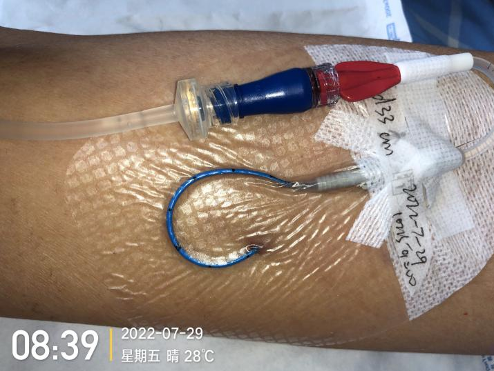 什么是医用导管固定贴导管固定总是出问题？教你 2 招，学会改良固定法_https://www.jmylbn.com_新闻资讯_第7张