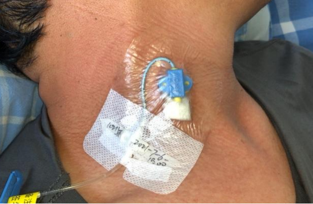 什么是医用导管固定贴导管固定总是出问题？教你 2 招，学会改良固定法_https://www.jmylbn.com_新闻资讯_第13张