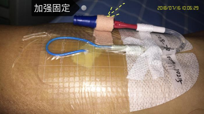 什么是医用导管固定贴导管固定总是出问题？教你 2 招，学会改良固定法_https://www.jmylbn.com_新闻资讯_第11张