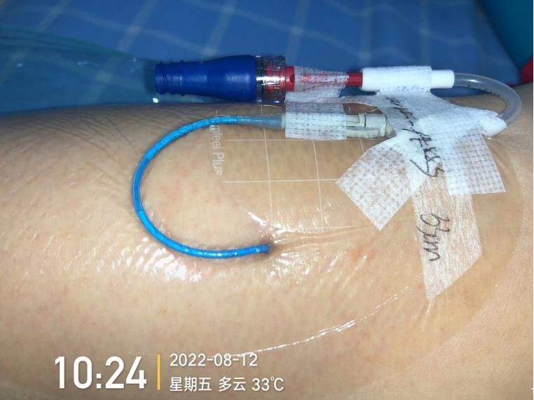什么是医用导管固定贴导管固定总是出问题？教你 2 招，学会改良固定法_https://www.jmylbn.com_新闻资讯_第10张