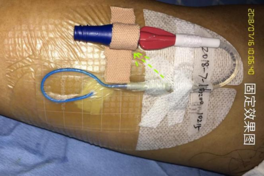 什么是医用导管固定贴导管固定总是出问题？教你 2 招，学会改良固定法_https://www.jmylbn.com_新闻资讯_第12张