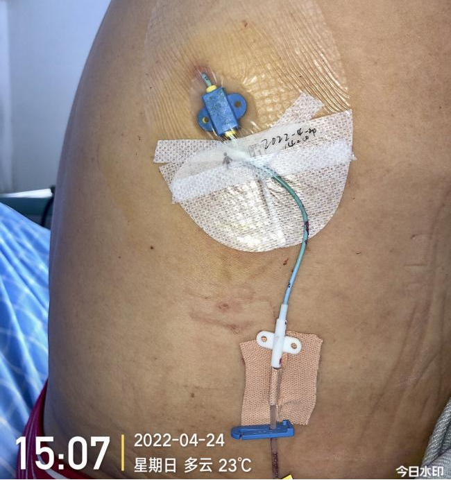 什么是医用导管固定贴导管固定总是出问题？教你 2 招，学会改良固定法_https://www.jmylbn.com_新闻资讯_第15张