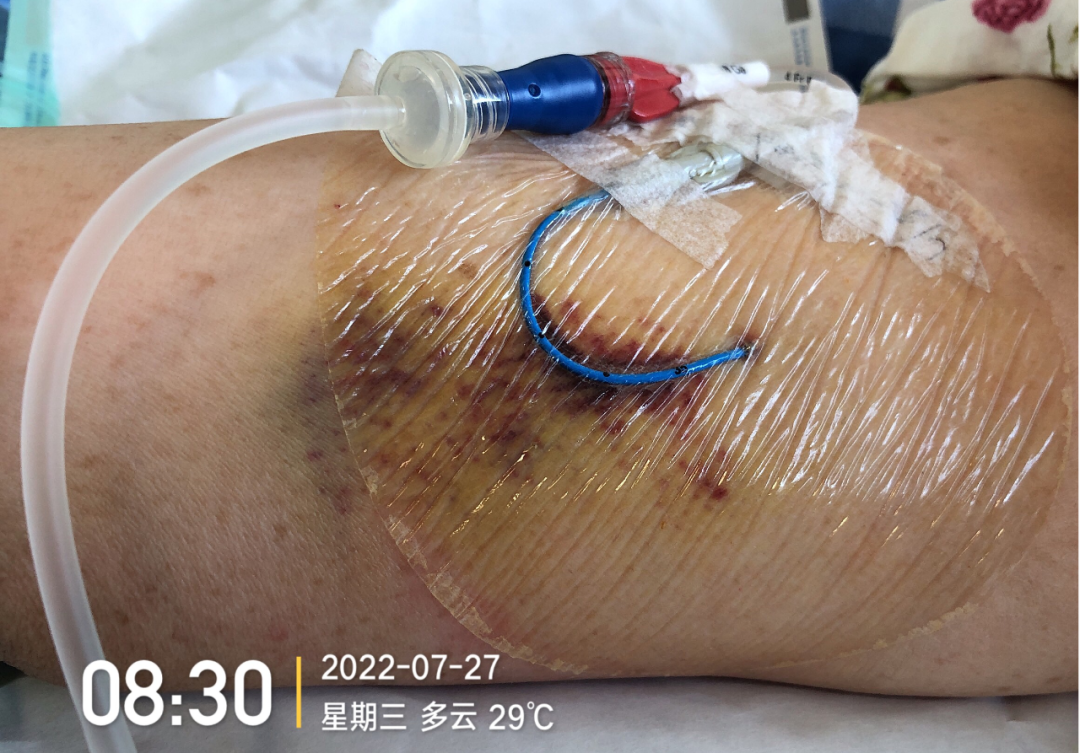 什么是医用导管固定贴导管固定总是出问题？教你 2 招，学会改良固定法_https://www.jmylbn.com_新闻资讯_第4张