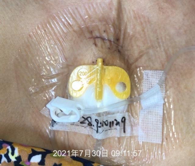 什么是医用导管固定贴导管固定总是出问题？教你 2 招，学会改良固定法_https://www.jmylbn.com_新闻资讯_第14张