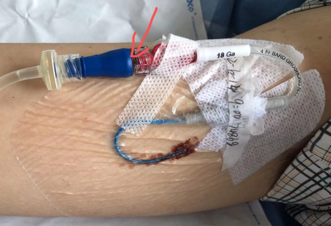 什么是医用导管固定贴导管固定总是出问题？教你 2 招，学会改良固定法_https://www.jmylbn.com_新闻资讯_第5张