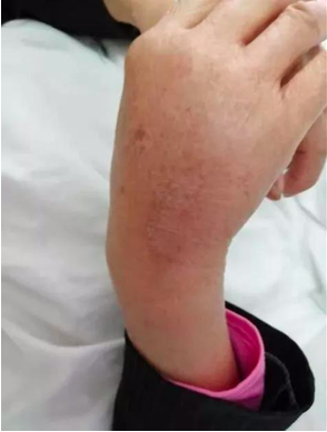 什么皮给药治​封闭治疗=皮下注射吗？药物外渗后的「封闭治疗」又是什么？_https://www.jmylbn.com_新闻资讯_第2张