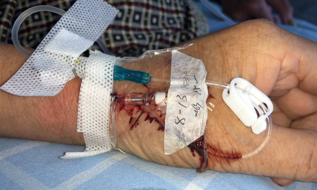 留置针胶布怎么撕应对留置针滴速减慢，这个方法「全国统一」？_https://www.jmylbn.com_新闻资讯_第7张