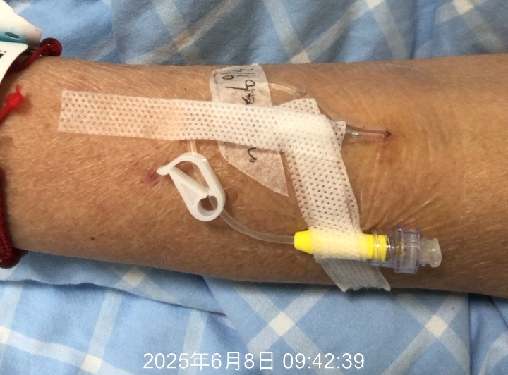 留置针胶布怎么撕应对留置针滴速减慢，这个方法「全国统一」？_https://www.jmylbn.com_新闻资讯_第3张