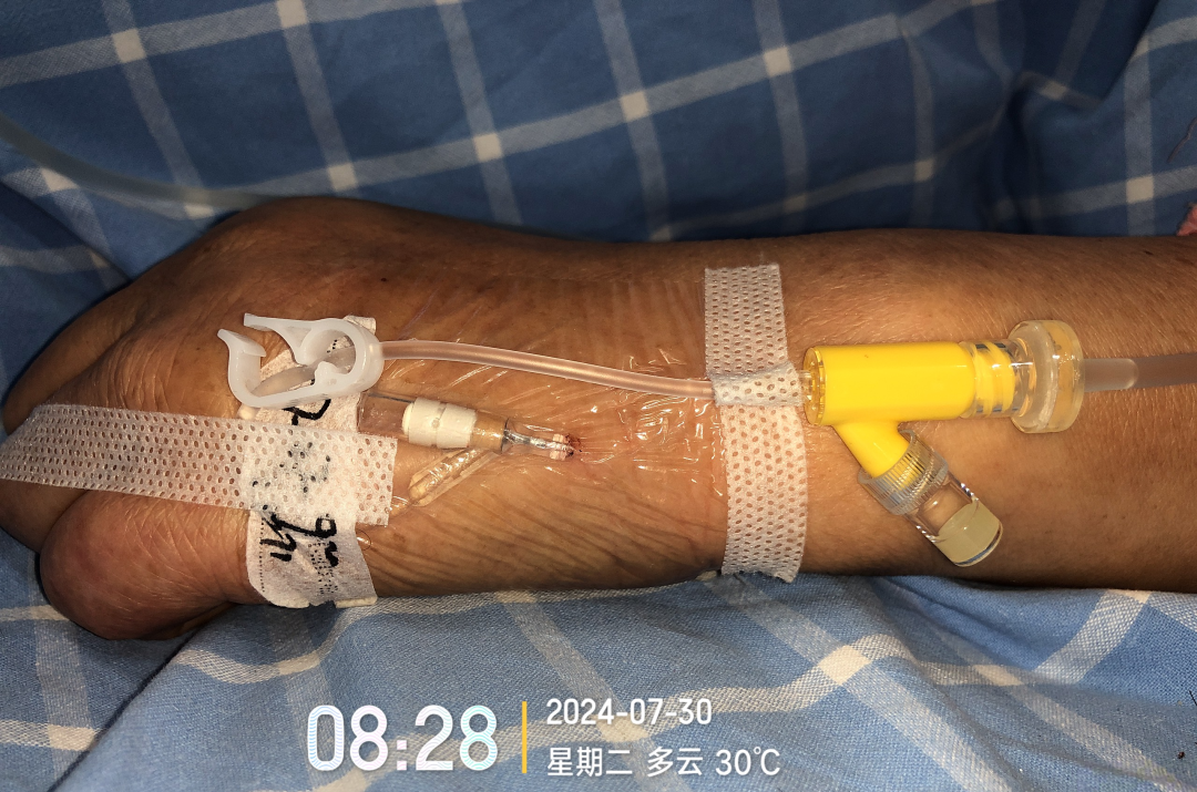 留置针胶布怎么撕应对留置针滴速减慢，这个方法「全国统一」？_https://www.jmylbn.com_新闻资讯_第5张