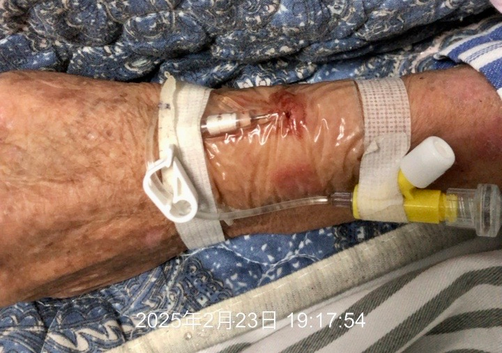 留置针胶布怎么撕应对留置针滴速减慢，这个方法「全国统一」？_https://www.jmylbn.com_新闻资讯_第8张