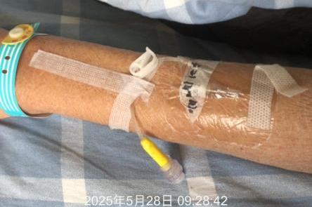 留置针胶布怎么撕应对留置针滴速减慢，这个方法「全国统一」？_https://www.jmylbn.com_新闻资讯_第4张