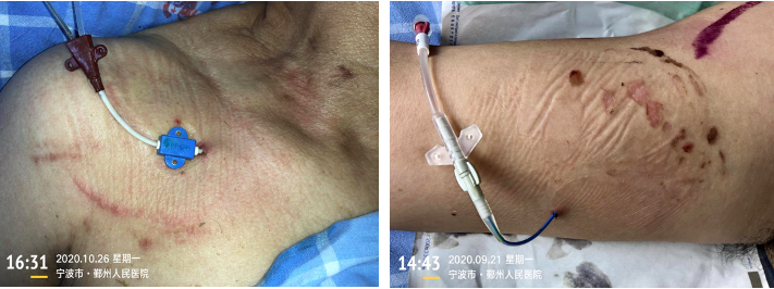 怎么撕敷料啊撕除敷料，一定要 0° 或 180° 角吗？有没有依据？_https://www.jmylbn.com_新闻资讯_第3张