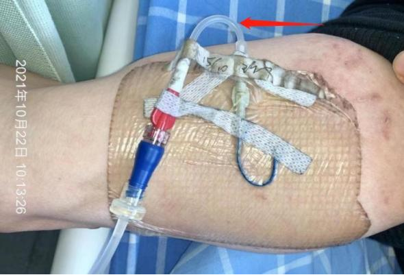 什么是医用导管固定贴导管固定总是出问题？教你 2 招，学会改良固定法_https://www.jmylbn.com_新闻资讯_第2张