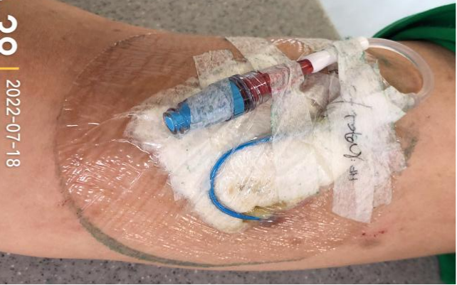 什么是医用导管固定贴导管固定总是出问题？教你 2 招，学会改良固定法_https://www.jmylbn.com_新闻资讯_第3张