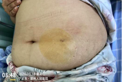 玻璃注射器怎么消毒皮下注射消毒用酒精还是碘伏？护理高手解答皮下注射 9 个常见问题_https://www.jmylbn.com_新闻资讯_第7张