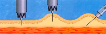 玻璃注射器怎么消毒皮下注射消毒用酒精还是碘伏？护理高手解答皮下注射 9 个常见问题_https://www.jmylbn.com_新闻资讯_第6张