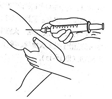 玻璃注射器怎么消毒皮下注射消毒用酒精还是碘伏？护理高手解答皮下注射 9 个常见问题_https://www.jmylbn.com_新闻资讯_第3张