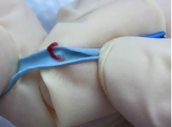 双腔cvc怎么开关双腔 CVC 一腔堵塞，还能继续使用吗？资深护士：这种情况可以_https://www.jmylbn.com_新闻资讯_第9张