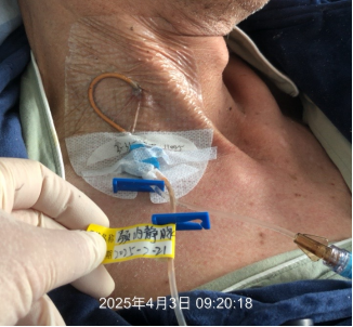 双腔cvc怎么开关双腔 CVC 一腔堵塞，还能继续使用吗？资深护士：这种情况可以_https://www.jmylbn.com_新闻资讯_第3张