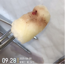双腔cvc怎么开关双腔 CVC 一腔堵塞，还能继续使用吗？资深护士：这种情况可以_https://www.jmylbn.com_新闻资讯_第7张