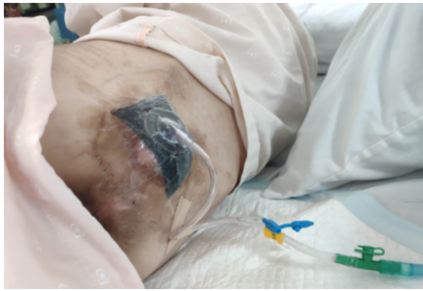 为什么负压可以引流管没有必要的引流管二次固定，一定要按护理部规定去执行吗？_https://www.jmylbn.com_新闻资讯_第4张