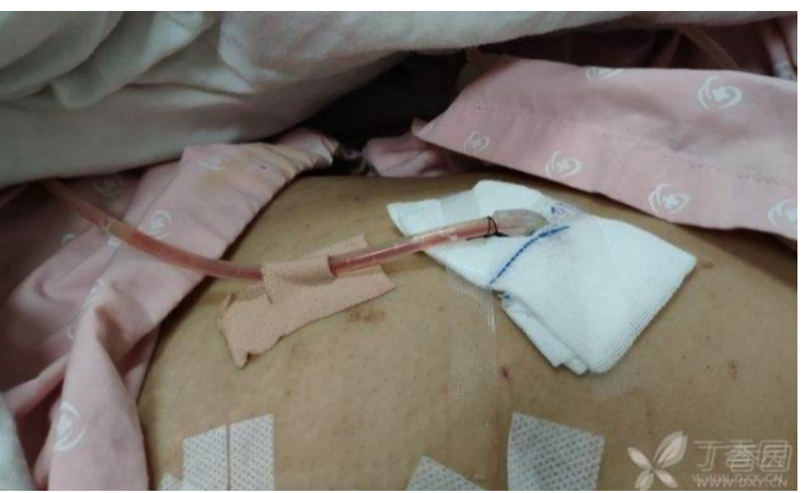 为什么负压可以引流管没有必要的引流管二次固定，一定要按护理部规定去执行吗？_https://www.jmylbn.com_新闻资讯_第3张