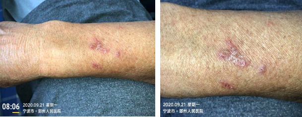 留置针怎么贴膜一撕一贴，留置针又现新的并发症！这个案例，转发提醒所有人_https://www.jmylbn.com_新闻资讯_第8张