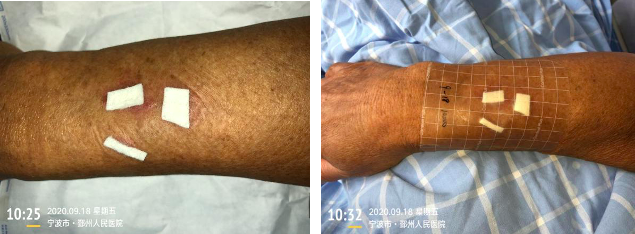 留置针怎么贴膜一撕一贴，留置针又现新的并发症！这个案例，转发提醒所有人_https://www.jmylbn.com_新闻资讯_第7张