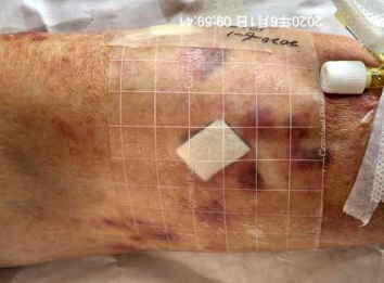 留置针怎么贴膜一撕一贴，留置针又现新的并发症！这个案例，转发提醒所有人_https://www.jmylbn.com_新闻资讯_第4张