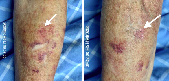 留置针怎么贴膜一撕一贴，留置针又现新的并发症！这个案例，转发提醒所有人_https://www.jmylbn.com_新闻资讯_第5张