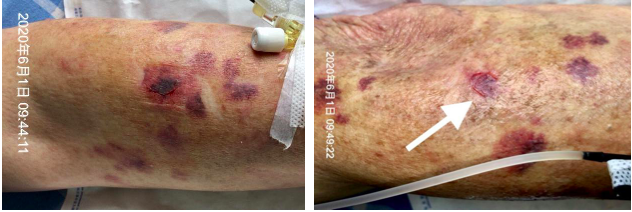 留置针怎么贴膜一撕一贴，留置针又现新的并发症！这个案例，转发提醒所有人_https://www.jmylbn.com_新闻资讯_第3张