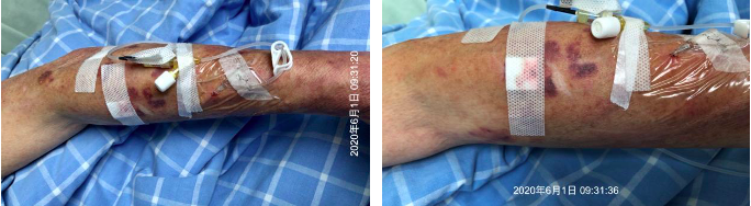 留置针怎么贴膜一撕一贴，留置针又现新的并发症！这个案例，转发提醒所有人_https://www.jmylbn.com_新闻资讯_第2张