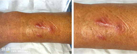 留置针怎么贴膜一撕一贴，留置针又现新的并发症！这个案例，转发提醒所有人_https://www.jmylbn.com_新闻资讯_第6张