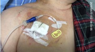 注射器毫升怎么看纠结：留置针冲封管，一定要用 10 ml 注射器吗？_https://www.jmylbn.com_新闻资讯_第9张