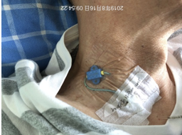 注射器毫升怎么看纠结：留置针冲封管，一定要用 10 ml 注射器吗？_https://www.jmylbn.com_新闻资讯_第8张