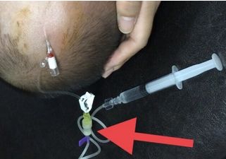 注射器毫升怎么看纠结：留置针冲封管，一定要用 10 ml 注射器吗？_https://www.jmylbn.com_新闻资讯_第6张