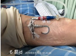 注射器毫升怎么看纠结：留置针冲封管，一定要用 10 ml 注射器吗？_https://www.jmylbn.com_新闻资讯_第7张