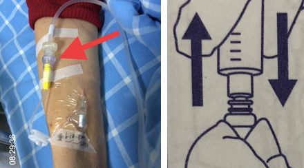 注射器毫升怎么看纠结：留置针冲封管，一定要用 10 ml 注射器吗？_https://www.jmylbn.com_新闻资讯_第5张