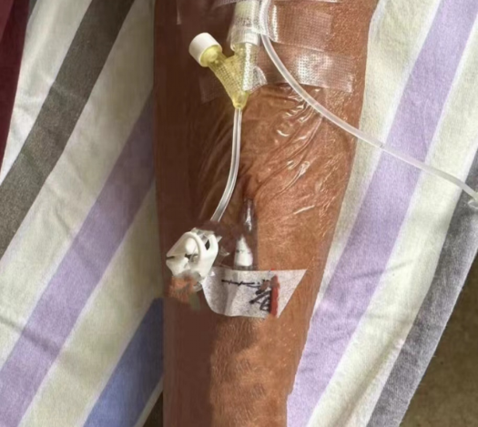 为什么输血不能用小针输注白蛋白，这 2 个注意事项一定要知道！_https://www.jmylbn.com_新闻资讯_第4张