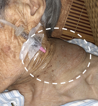 bd留置针怎么使用病人都休克了，留置针打不上怎么办？教你一招！_https://www.jmylbn.com_新闻资讯_第5张